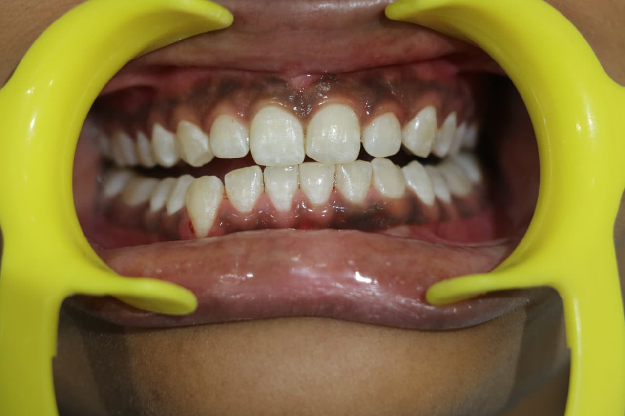 After treatment