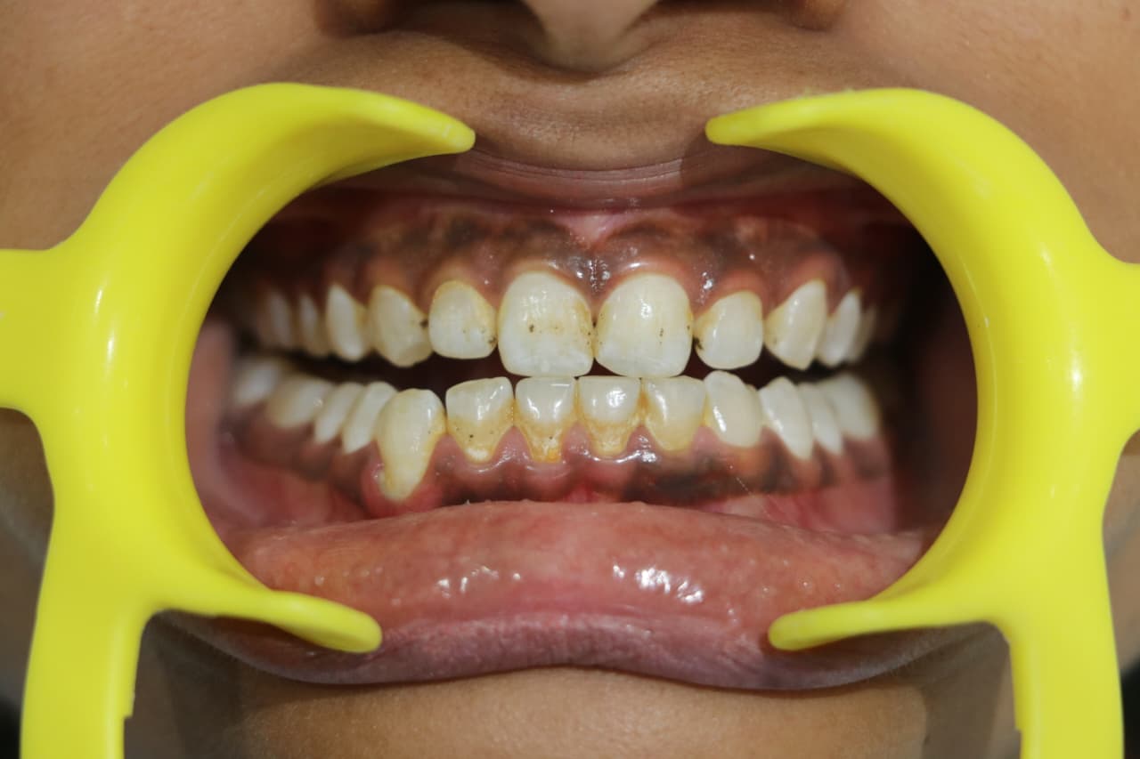 Before treatment